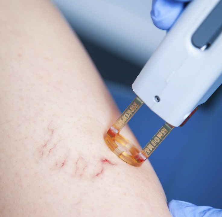 laser vasculaire